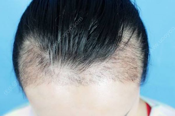 为什么发际线越来越高？发际线高该怎么办？(1)