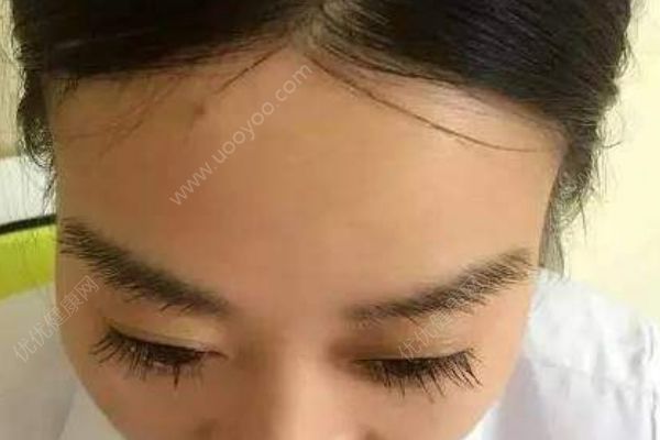 为什么发际线越来越高？发际线高该怎么办？(2)